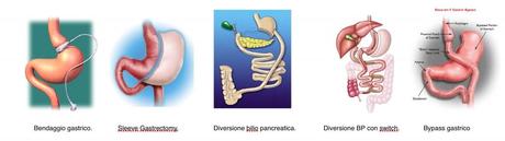 A mali estremi… Vi presento la Chirurgia Bariatrica