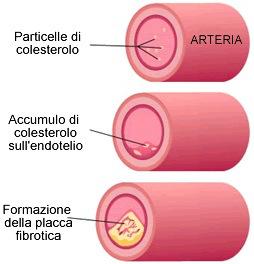 aterosclerosi