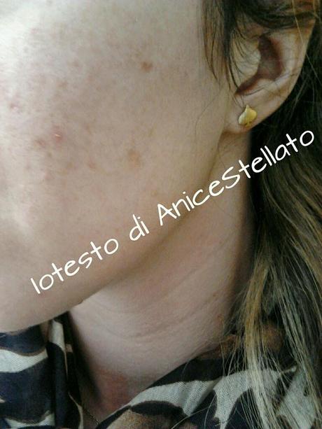 Ridurre macchie, rughe e cicatrici dell'acne : maschera BRUCIANTE alla cannella