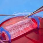 Vagina sintetica creata in laboratorio e impiantata su 4 ragazze