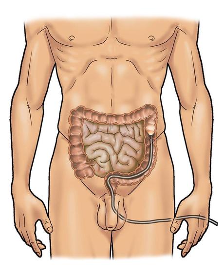 Click Salute n.30 - L'endoscopia digestiva - Figura 2