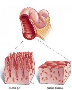 La celiachia: cause, sintomi e diagnosi 