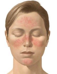 Rosacea