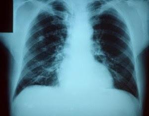 Belluno casi di polmonite atipica