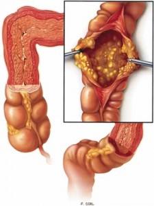 Clostridium difficile