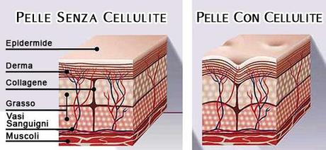 cellulite