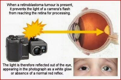 La meravigliosa storia del piccolo Denis,retinoblastoma curato col Metodo Di Bella.