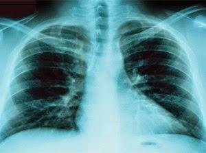 Cause del tumore al polmone ricerca europea
