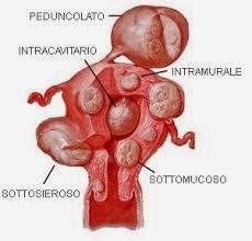 Dany e la dieta dei gs, fibromi, attacchi di panico,mal di testa, depressione.