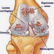 Leonia, e la dieta dei gs:dolori alle giunture e protesi al ginocchio