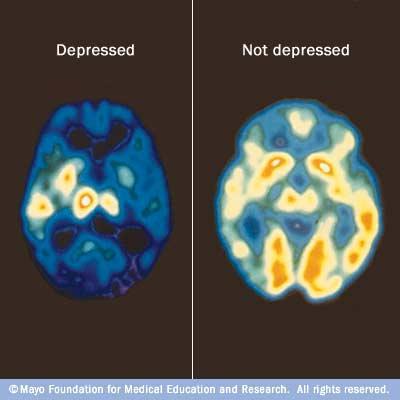 La depressione nel cervello
