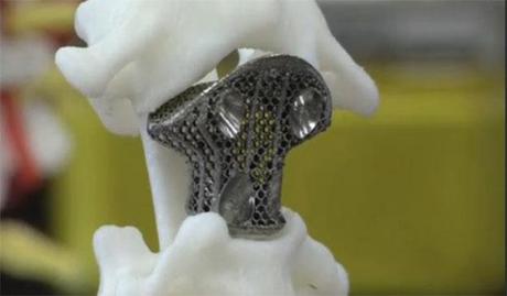 Stampata per la prima volta una vertebra con il 3D Printig