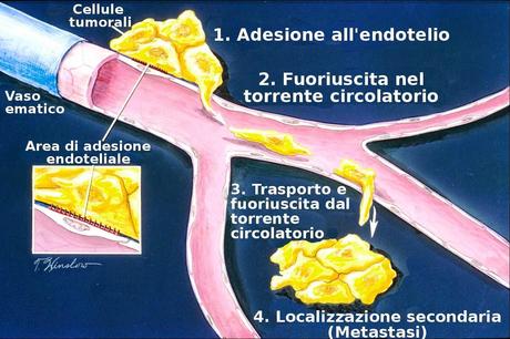 Come fermare le metastasi del cancro: due studi recenti