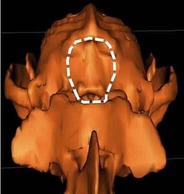 SIRINGOMIELIA NEL CANE:UNA MALATTIA EMERGENTE