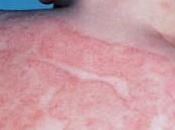 Eczema