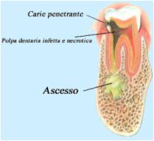 ascesso dentario1 Ascesso dentale