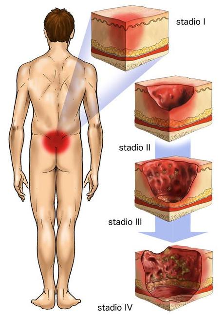 Come si riconoscono le lesioni da decubito?