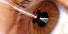 Kamra: foro stenopeico inserito chirurgicamente nella cornea presbiti