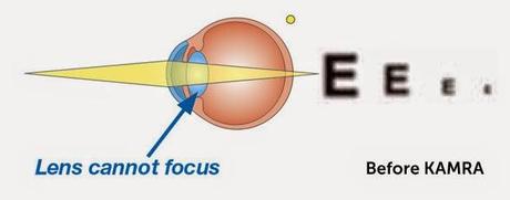 Kamra: il foro stenopeico inserito chirurgicamente nella cornea dei presbiti