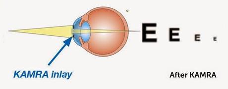 Kamra: il foro stenopeico inserito chirurgicamente nella cornea dei presbiti