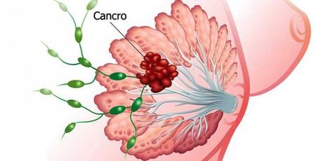 Cancro al seno