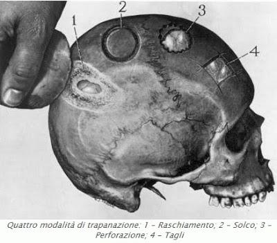 Archeologia medica. La trapanazione del cranio a scopi terapeutici.