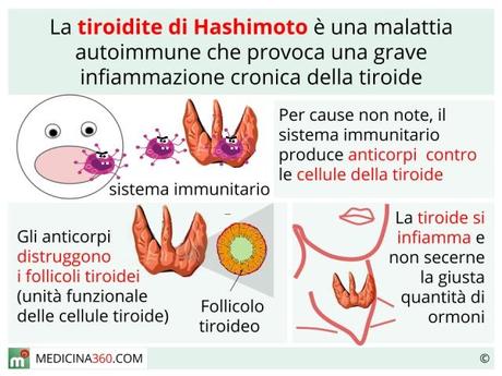 tiroide di hashimoto