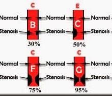 Sclerosi Multipla e CCSVI: cattiva condotta scientifica?