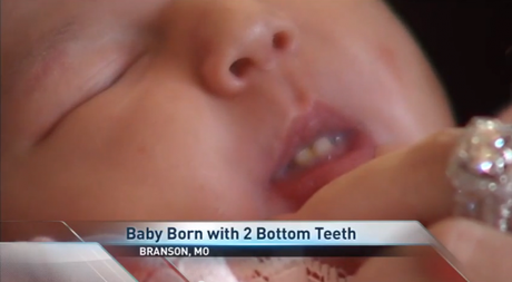 Neonata nasce con due denti inferiori, la fotografia spopola sul web