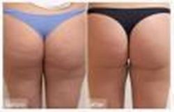 Cellulite