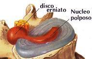 Con la Chiropratica Si Può Risolvere l’Ernia Del Disco (Intervertebrale).