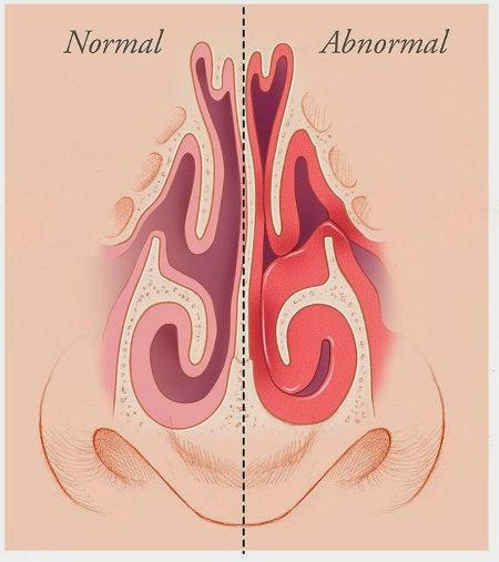 Spray nasale green per la sinusite - parte quinta