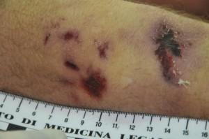 Un particolare del corpo senza vita di Riccardo Magherini (rainews.it)