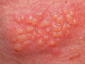 Herpes genitale: i sintomi