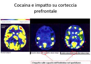 effetti della cocaina
