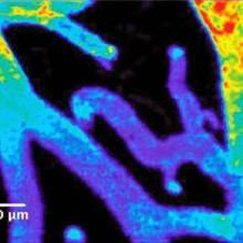 Sclerosi Multipla e CCSVI: mettiamo assieme i pezzi