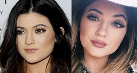 Kylie Jenner: chirurgia estetica