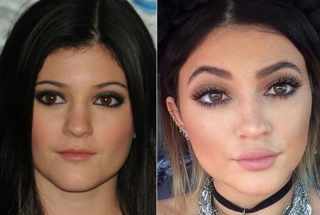 Kylie Jenner: chirurgia estetica