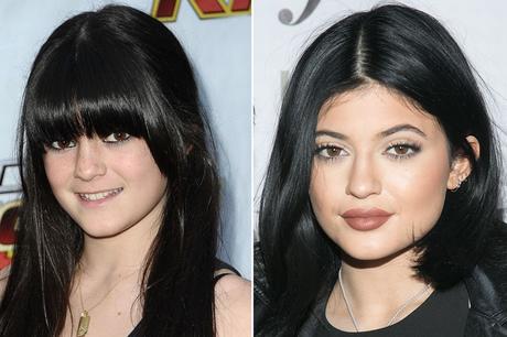 Kylie Jenner: chirurgia estetica