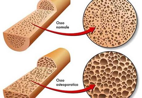 Osteoporosi