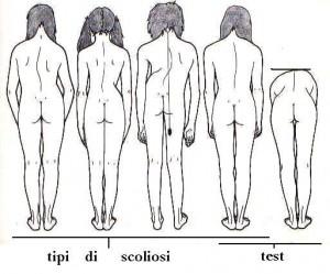 Lo Yoga nel trattamento delle Scoliosi