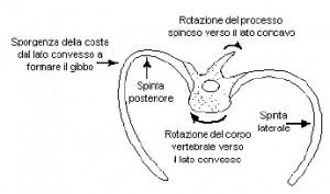 Lo Yoga nel trattamento delle Scoliosi