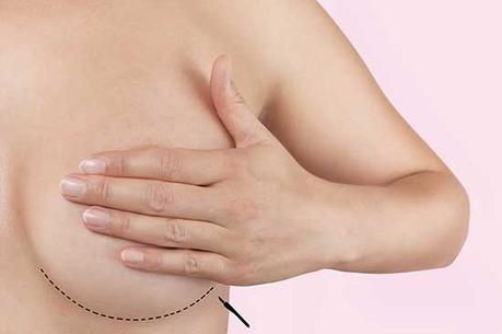 Mastectomia preventiva