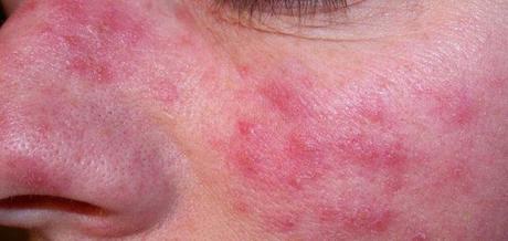 MILANO. 27 aprile: primo Global Rosacea Tweetathon e via Twitter si discute in #ChatRosacea.