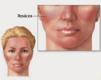 MILANO. 27 aprile: primo Global Rosacea Tweetathon e via Twitter si discute in #ChatRosacea.