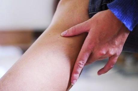 Rimedi naturali ai Capillari fragili