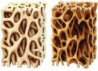 Fiori di Bach rimedi all'osteoporosi ossa fragili