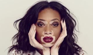 Chantelle Winnie, la TopModel con la vitiligine: testimonial per Desigual