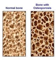 Pilates, prevenire l’osteoporosi