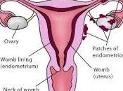 MILANO. Giornata Ricerca sull’Endometriosi: studio sulla componente genetica della malattia